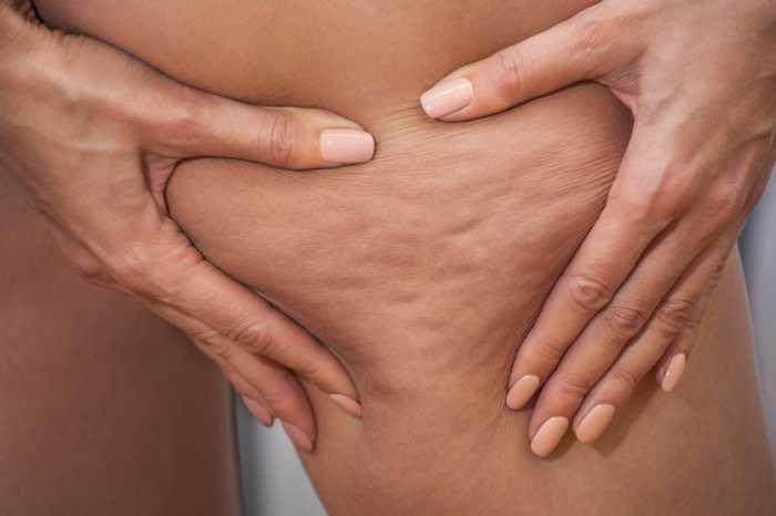 Somatoline cellulite : description, avis et efficacité