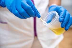 Urine foncée : faut-il s’inquiéter ? Quelles en sont les causes ?