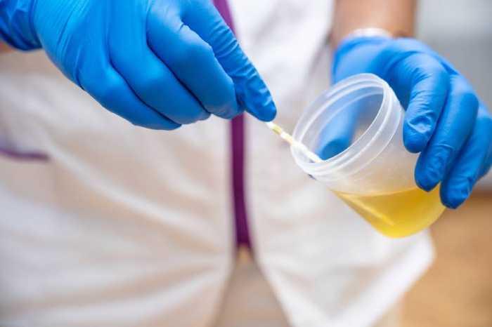 Urine foncée : faut-il s’inquiéter ? Quelles en sont les causes ?