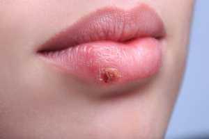 Herpès labial : symptômes, causes et traitements des boutons de fièvre