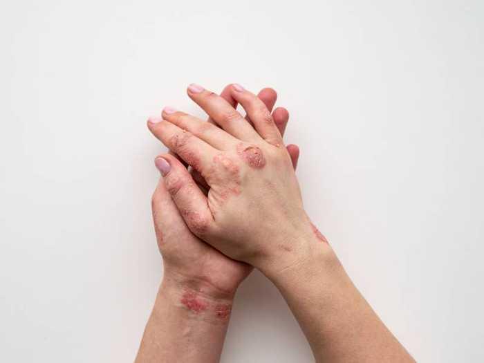 Quels sont les traitements efficaces contre le psoriasis ? Naturel et sans ordonnance