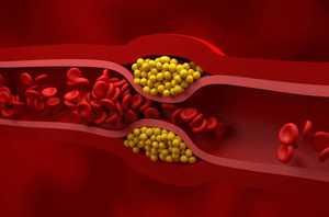 Médicament cholestérol : sans statine, dangereux et le meilleur