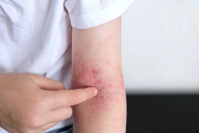 Eczéma : symptômes, causes et traitements