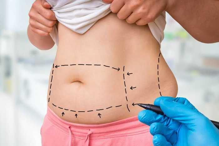 Liposuccion ventre : avant-après, ratée et chez l’homme