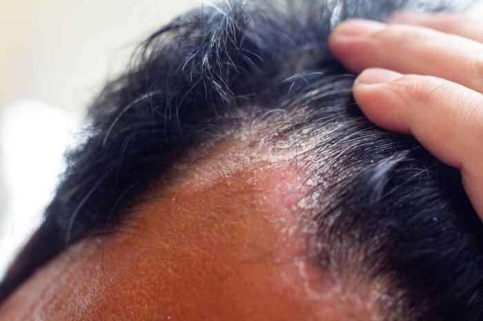 Psoriasis cuir chevelu : traitement, soin et remèdes naturels